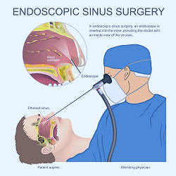 Nasal Polyps - Overview, Diagnosis & Treatment | Auricle ENT Clinic